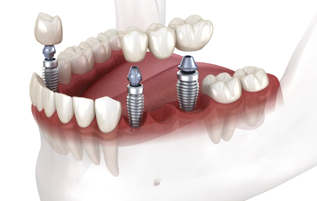 Single Tooth Implant Dentistes à Cagnes-sur-Mer, Drs Payam & Pegah Gandjidadeh