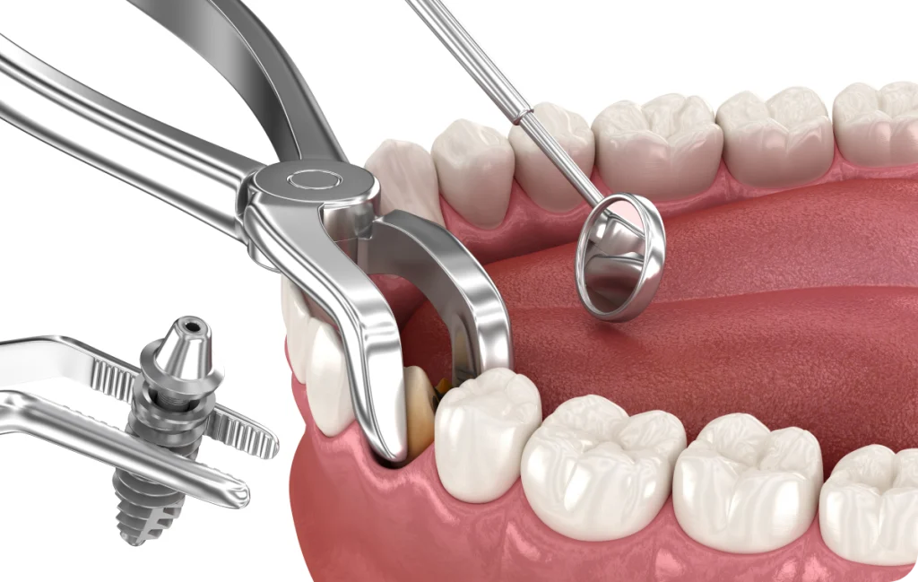 Immediate extraction/implant placement Dentistes à Cagnes-sur-Mer, Drs Payam & Pegah Gandjidadeh