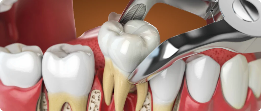 Immediate extraction/implant placement