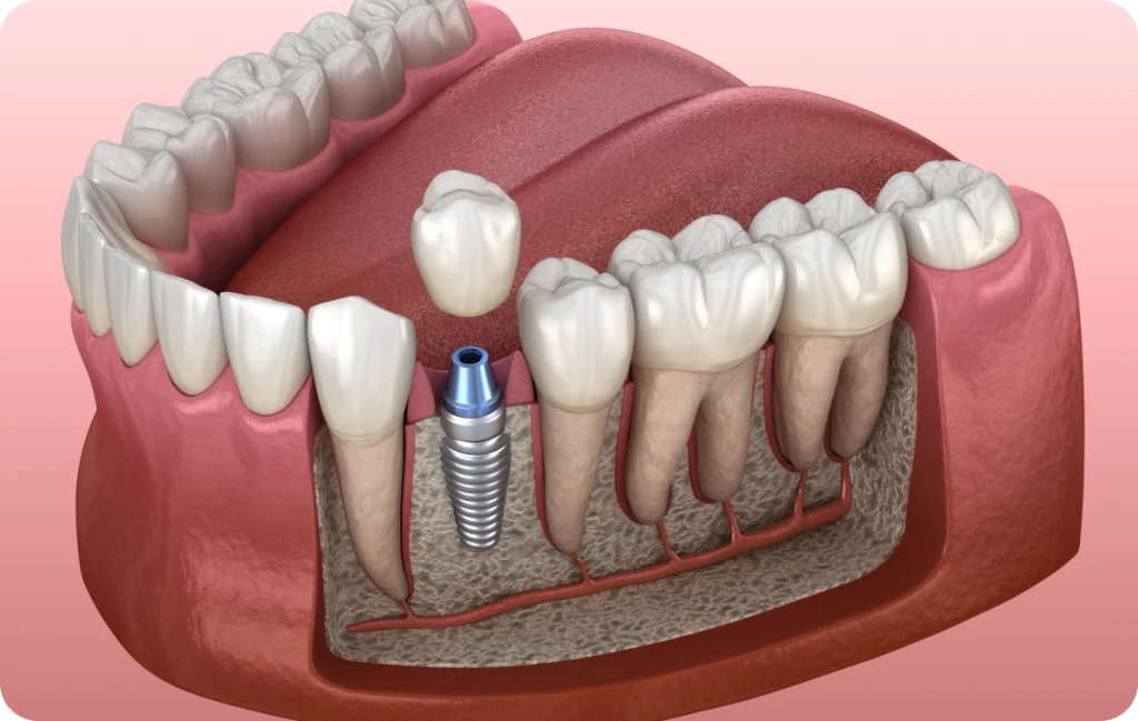 Single Tooth Implant Dentistes à Cagnes-sur-Mer, Drs Payam & Pegah Gandjidadeh