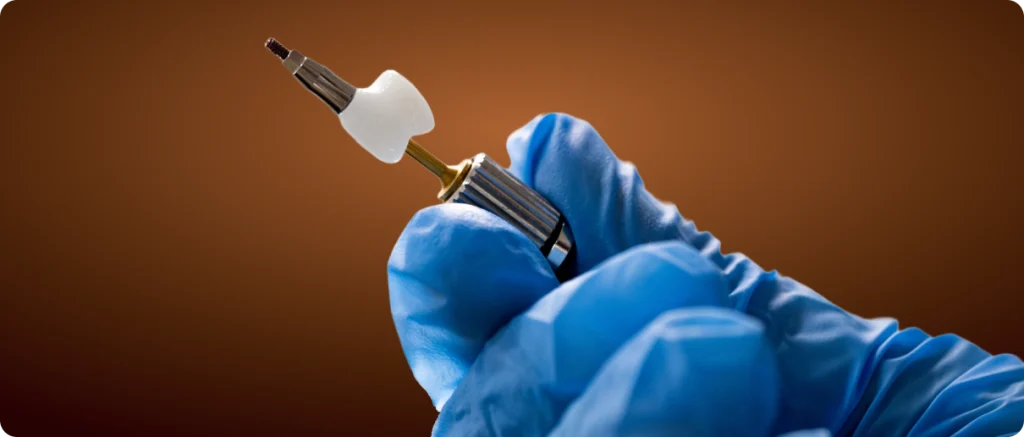 Single Tooth Implant