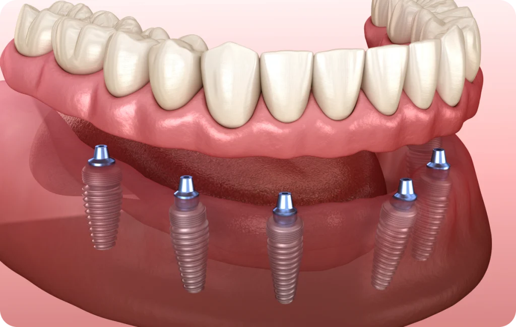 All-on-4 / All-on-6 Dentistes à Cagnes-sur-Mer, Drs Payam & Pegah Gandjidadeh