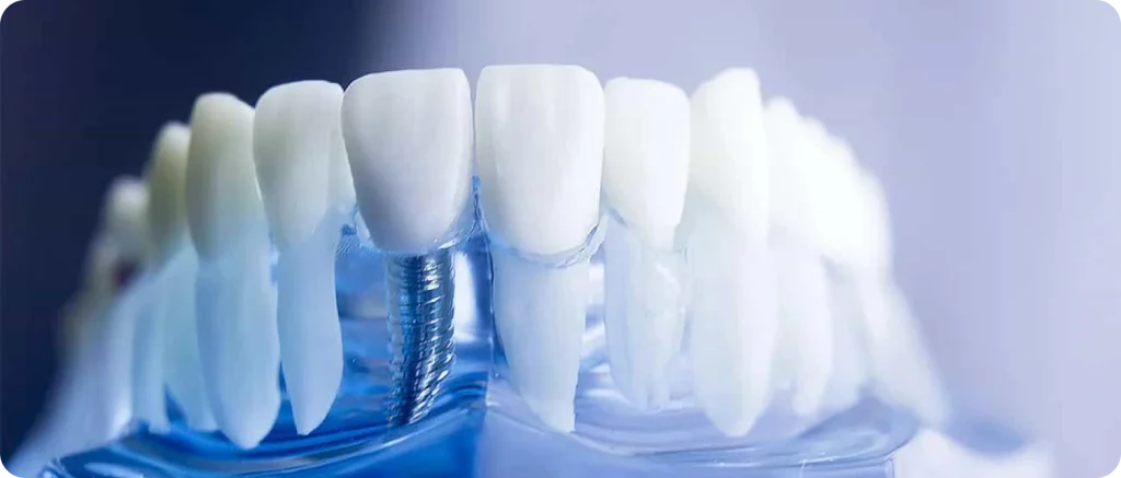 Single Tooth Implant Dentistes à Cagnes-sur-Mer, Drs Payam & Pegah Gandjidadeh