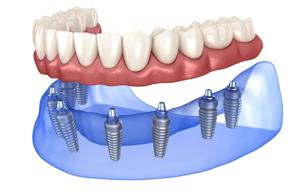 All-on-4 / All-on-6 Dentistes à Cagnes-sur-Mer, Drs Payam & Pegah Gandjidadeh