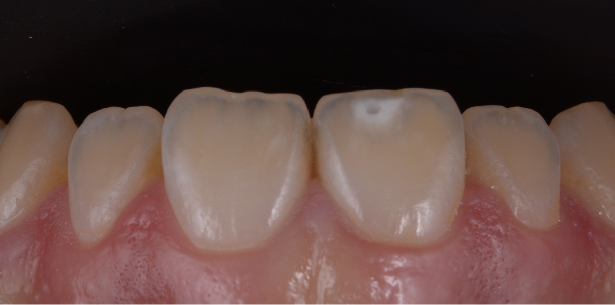 Clinical Cases Dentistes à Cagnes-sur-Mer, Drs Payam & Pegah Gandjidadeh