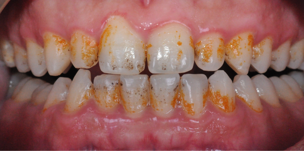 Clinical Cases Dentistes à Cagnes-sur-Mer, Drs Payam & Pegah Gandjidadeh