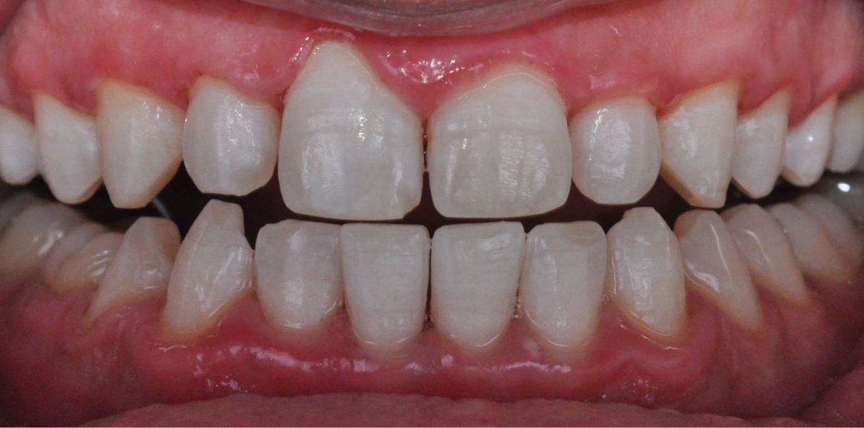 Clinical Cases Dentistes à Cagnes-sur-Mer, Drs Payam & Pegah Gandjidadeh