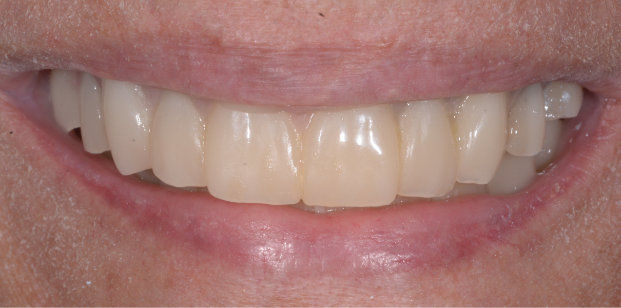 Clinical Cases Dentistes à Cagnes-sur-Mer, Drs Payam & Pegah Gandjidadeh