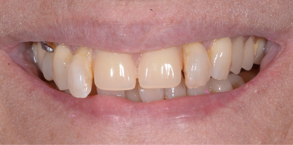 Clinical Cases Dentistes à Cagnes-sur-Mer, Drs Payam & Pegah Gandjidadeh