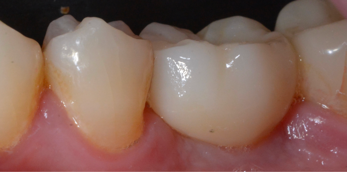 Clinical Cases Dentistes à Cagnes-sur-Mer, Drs Payam & Pegah Gandjidadeh