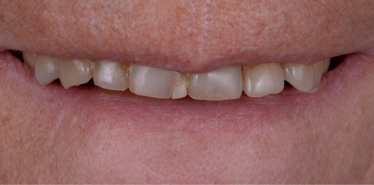 Clinical Cases Dentistes à Cagnes-sur-Mer, Drs Payam & Pegah Gandjidadeh