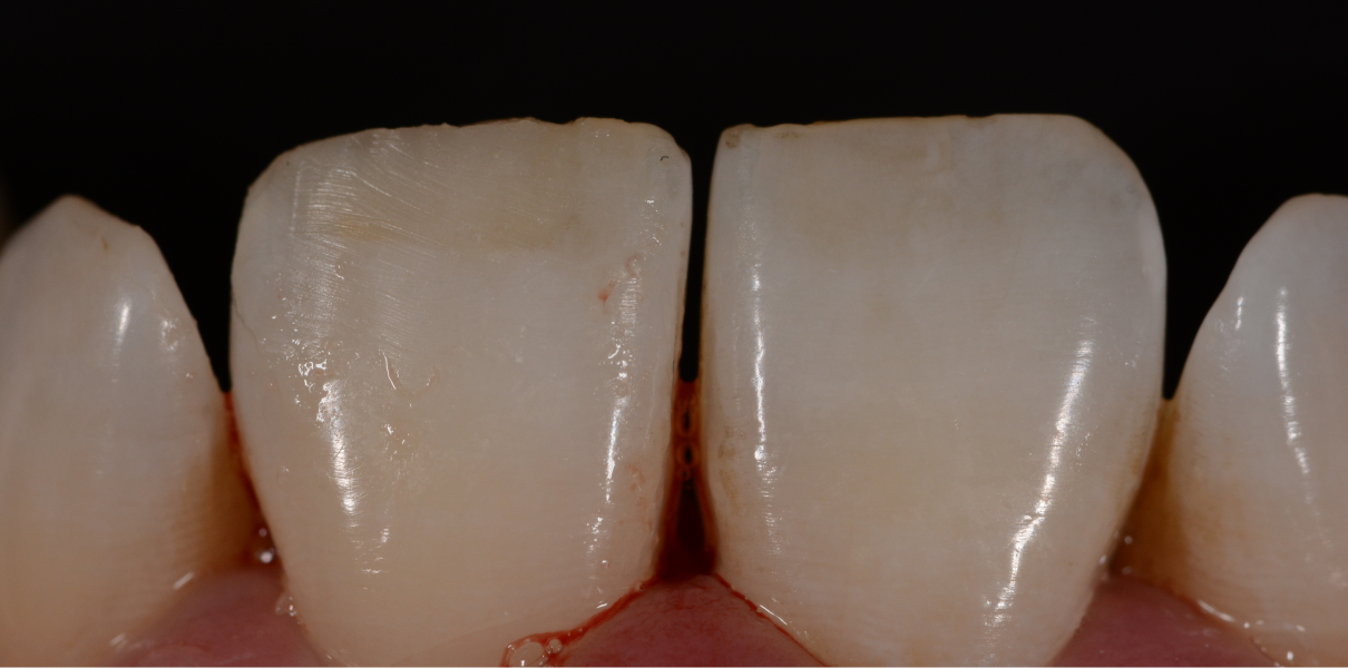 Clinical Cases Dentistes à Cagnes-sur-Mer, Drs Payam & Pegah Gandjidadeh