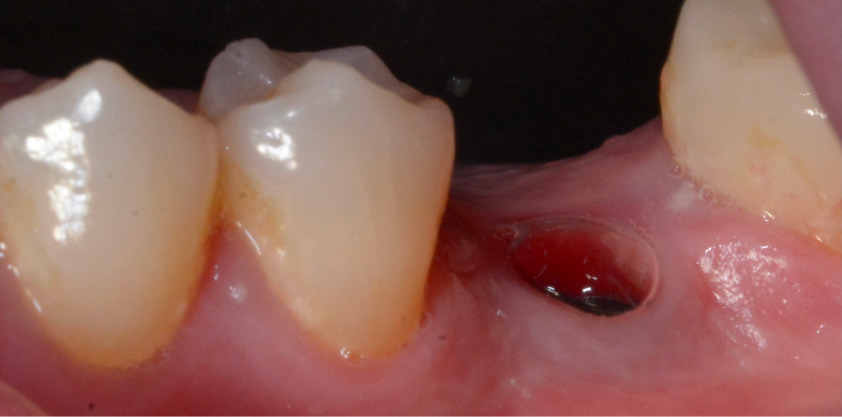 Clinical Cases Dentistes à Cagnes-sur-Mer, Drs Payam & Pegah Gandjidadeh