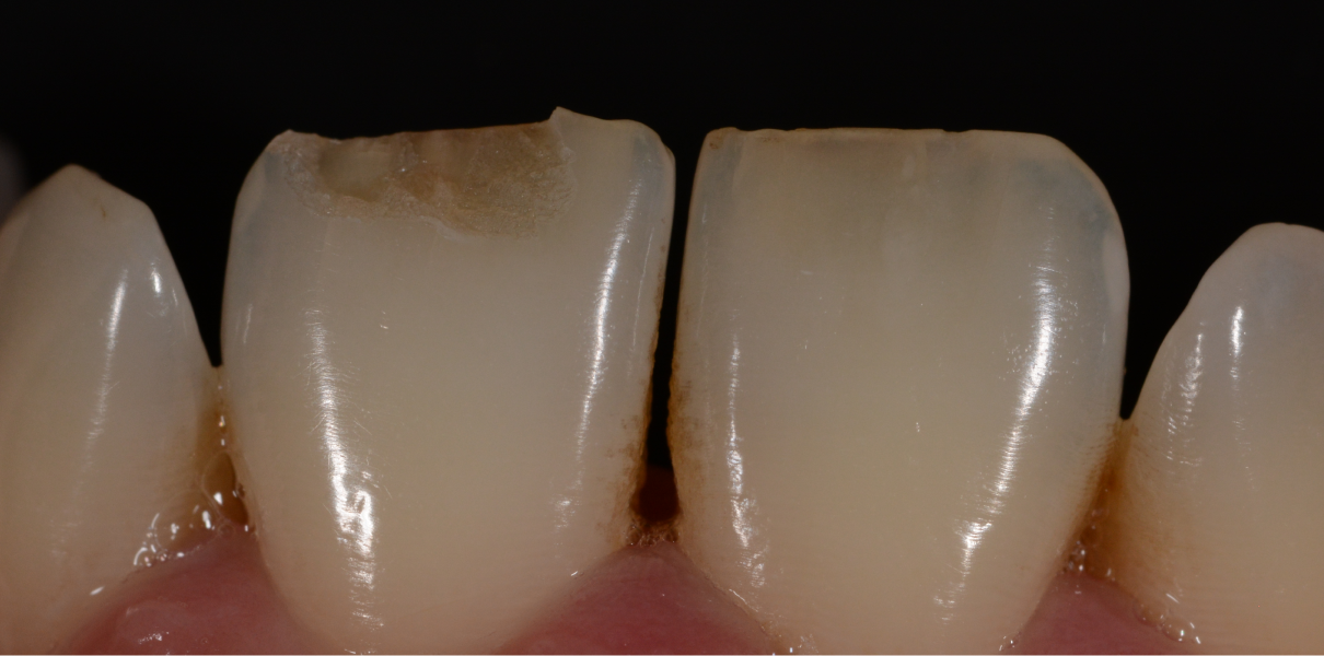 Clinical Cases Dentistes à Cagnes-sur-Mer, Drs Payam & Pegah Gandjidadeh