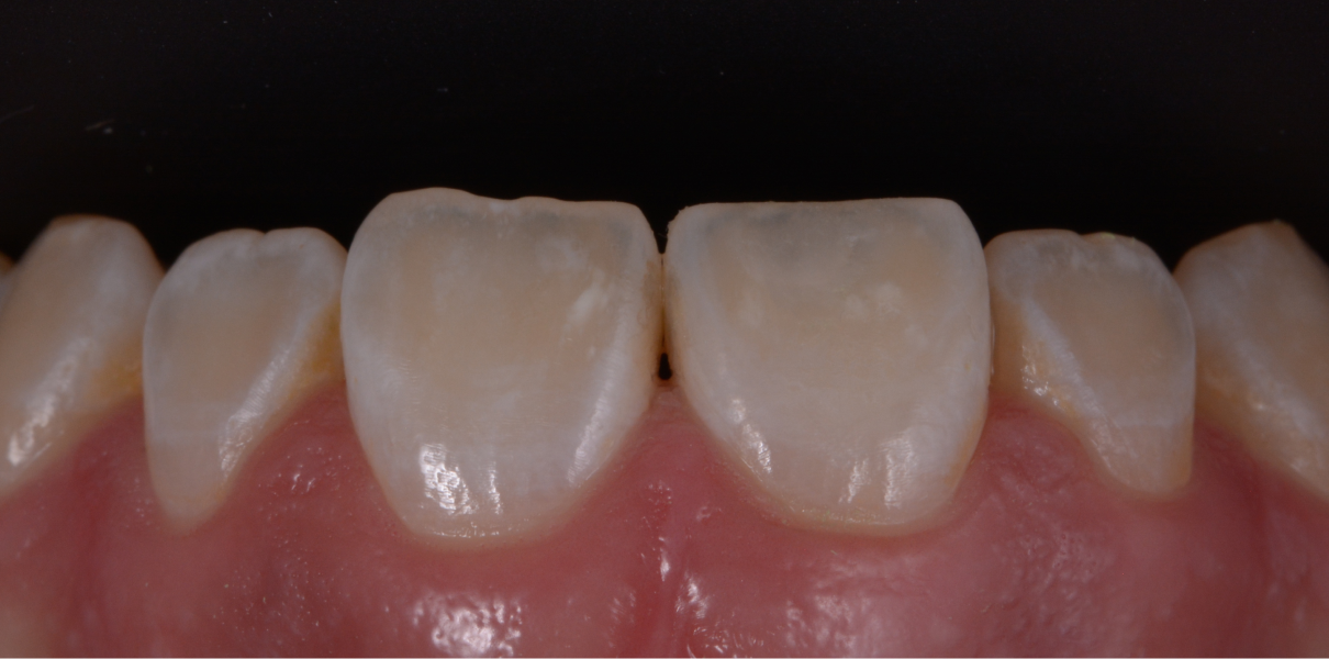 Clinical Cases Dentistes à Cagnes-sur-Mer, Drs Payam & Pegah Gandjidadeh