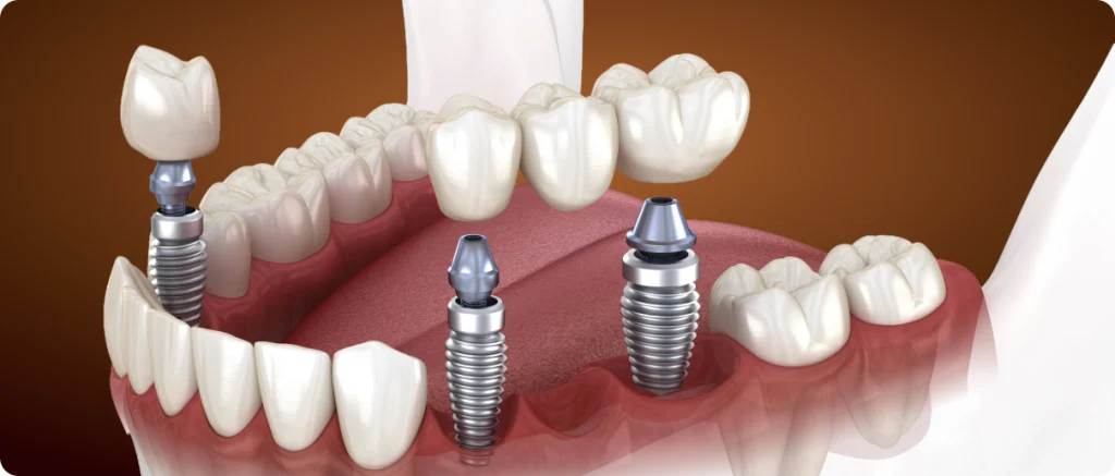 Crowns and Bridges on Implants