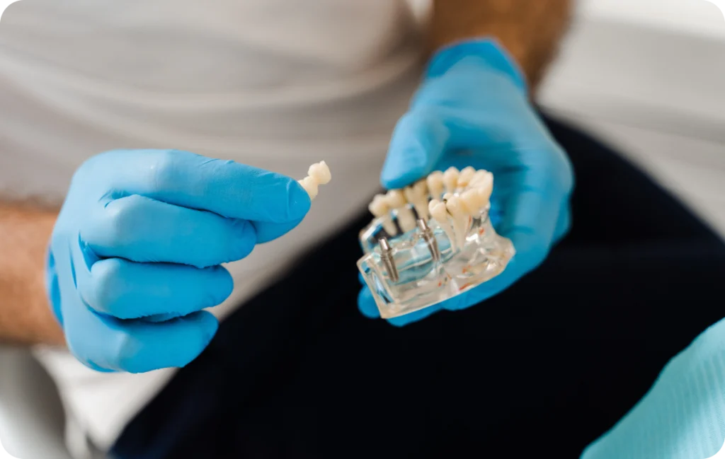 Crowns and Bridges on Implants Dentistes à Cagnes-sur-Mer, Drs Payam & Pegah Gandjidadeh