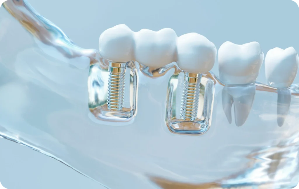Crowns and Bridges on Implants Dentistes à Cagnes-sur-Mer, Drs Payam & Pegah Gandjidadeh