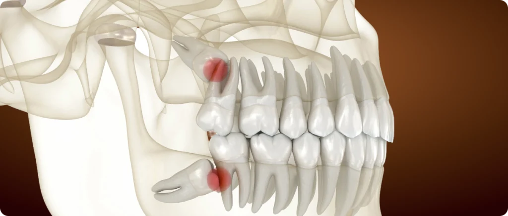 Wisdom Teeth