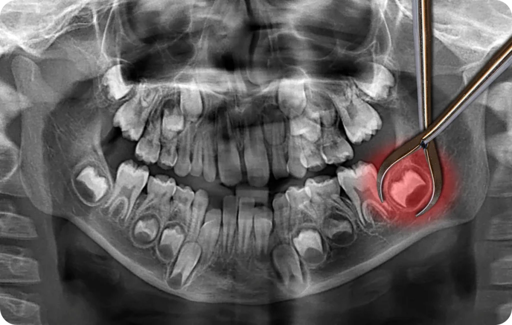 Wisdom Teeth Dentistes à Cagnes-sur-Mer, Drs Payam & Pegah Gandjidadeh