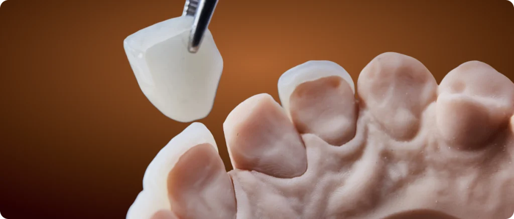 Dental Veneer