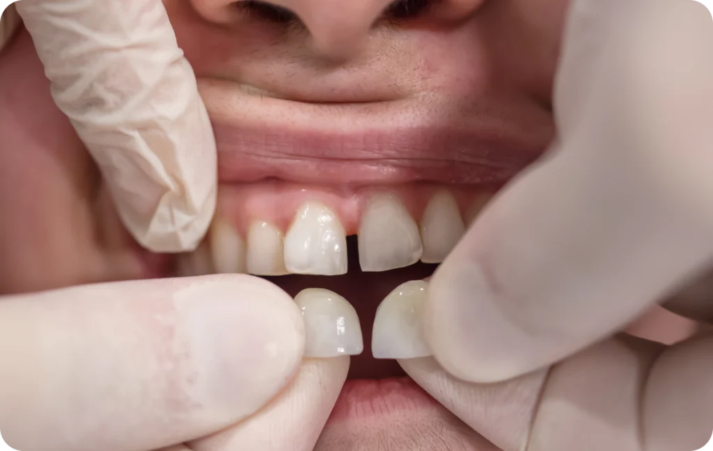 Dental Veneer Dentistes à Cagnes-sur-Mer, Drs Payam & Pegah Gandjidadeh