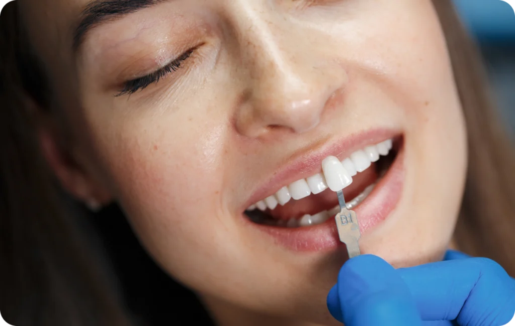 Dental Veneer Dentistes à Cagnes-sur-Mer, Drs Payam & Pegah Gandjidadeh