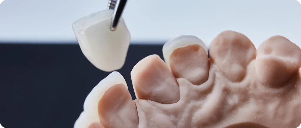 Dental Veneer Dentistes à Cagnes-sur-Mer, Drs Payam & Pegah Gandjidadeh