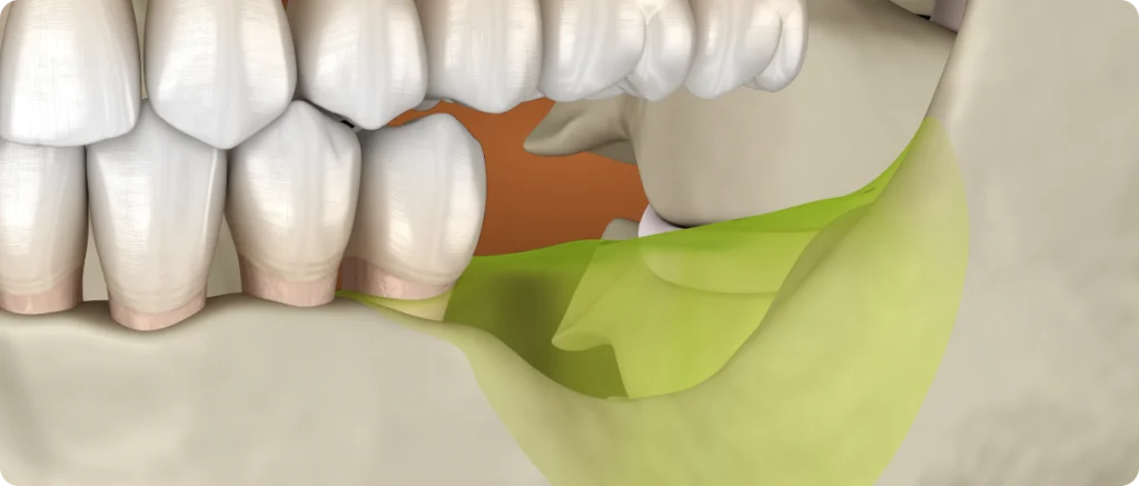 Bone graft