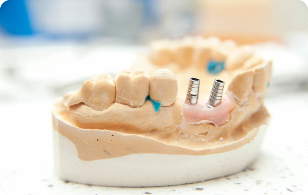 Bone graft Dentistes à Cagnes-sur-Mer, Drs Payam & Pegah Gandjidadeh