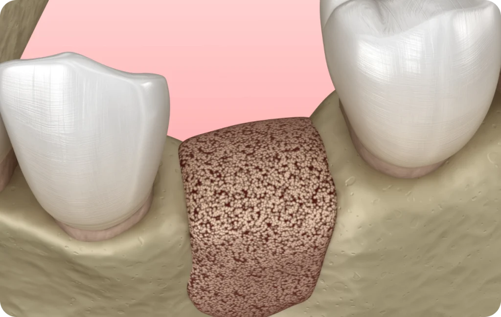 Bone graft Dentistes à Cagnes-sur-Mer, Drs Payam & Pegah Gandjidadeh