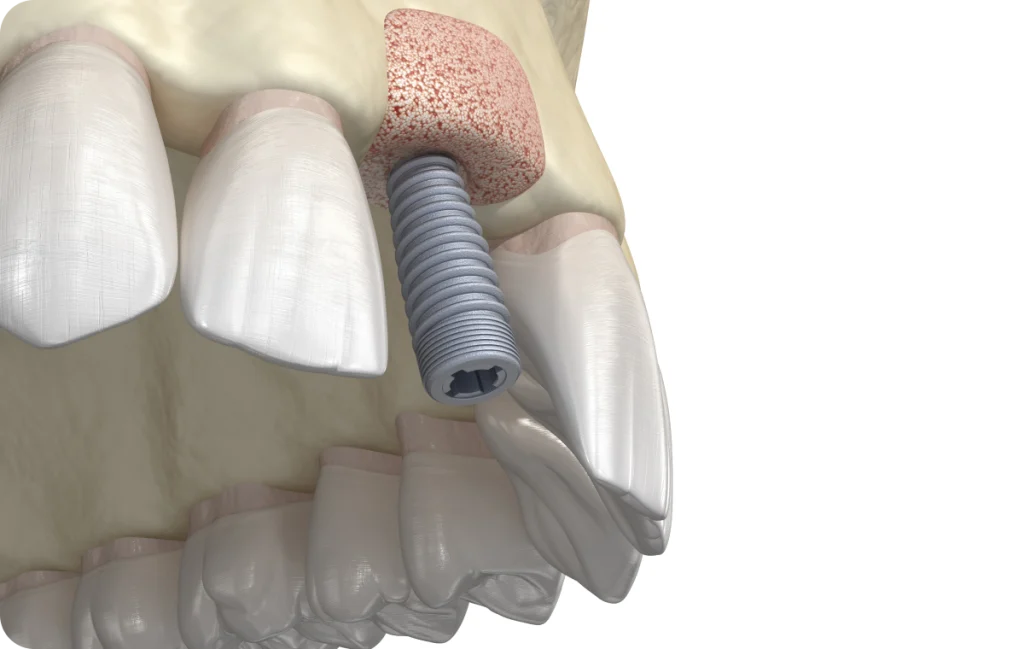 Bone graft Dentistes à Cagnes-sur-Mer, Drs Payam & Pegah Gandjidadeh