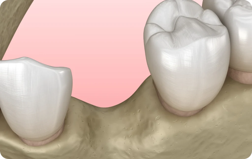 Bone graft Dentistes à Cagnes-sur-Mer, Drs Payam & Pegah Gandjidadeh