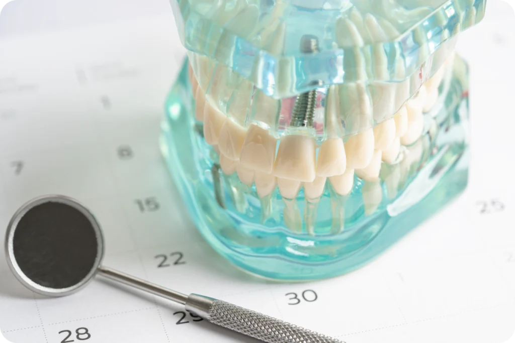 Dental implant in Vence Dentistes à Cagnes-sur-Mer, Drs Payam & Pegah Gandjidadeh