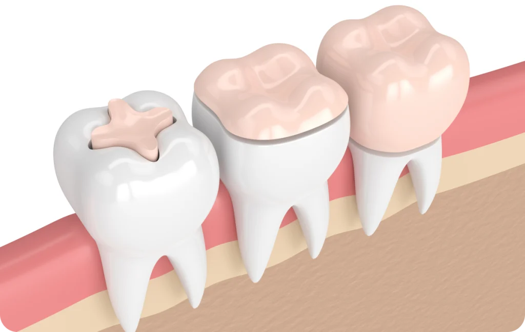 inlay onlay cagnes sur mer durabilite Inlay / Onlay Dentistes à Cagnes-sur-Mer, Drs Payam & Pegah Gandjidadeh
