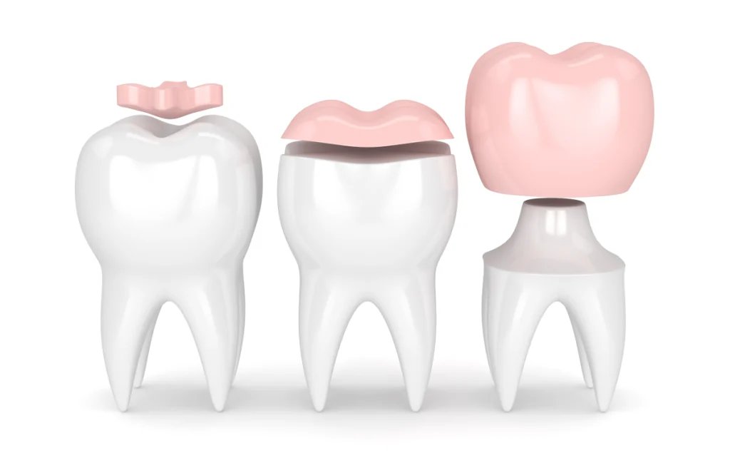 inlay onlay cagnes sur mer precision Inlay / Onlay Dentistes à Cagnes-sur-Mer, Drs Payam & Pegah Gandjidadeh