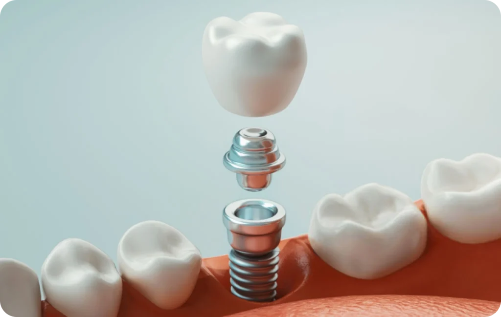 Immediate loading Dentistes à Cagnes-sur-Mer, Drs Payam & Pegah Gandjidadeh
