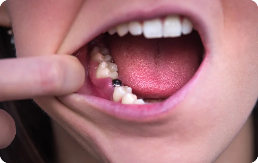 Immediate loading Dentistes à Cagnes-sur-Mer, Drs Payam & Pegah Gandjidadeh