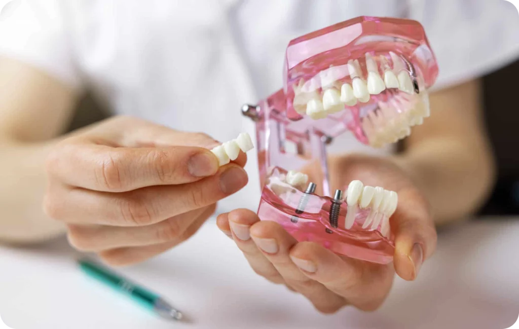 Removable Implant-Supported Denture Dentistes à Cagnes-sur-Mer, Drs Payam & Pegah Gandjidadeh