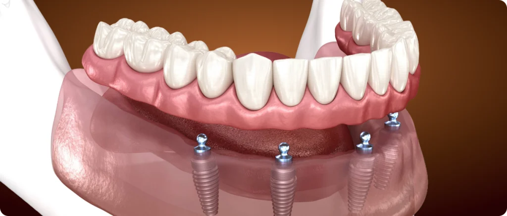 Removable Implant-Supported Denture