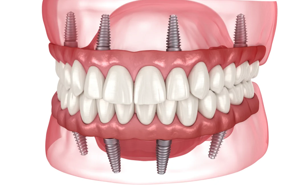 Removable Implant-Supported Denture Dentistes à Cagnes-sur-Mer, Drs Payam & Pegah Gandjidadeh