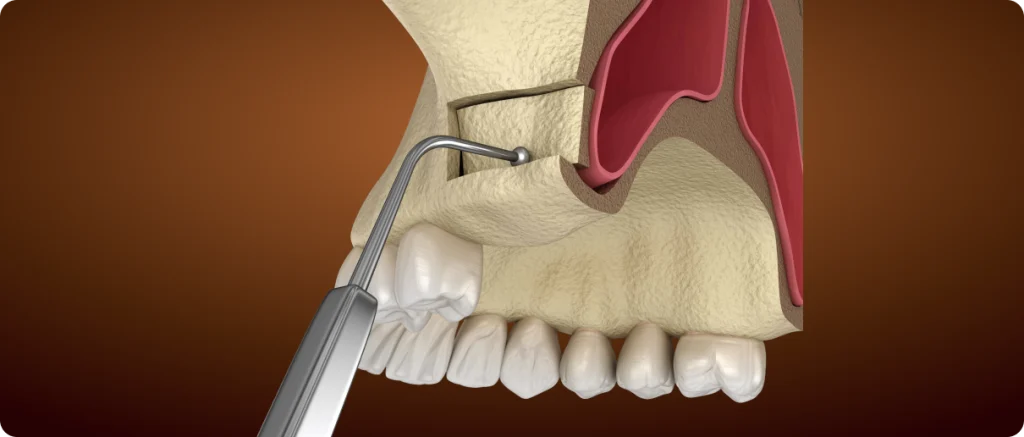 Sinus lift
