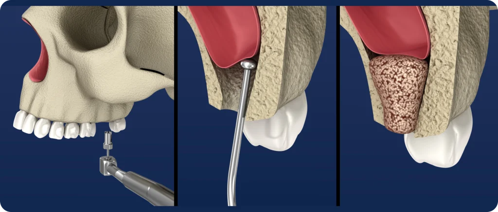 Sinus lift Dentistes à Cagnes-sur-Mer, Drs Payam & Pegah Gandjidadeh