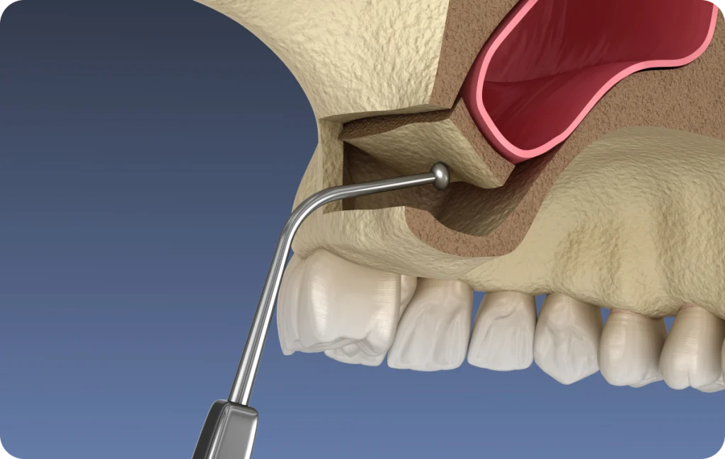 Sinus lift Dentistes à Cagnes-sur-Mer, Drs Payam & Pegah Gandjidadeh