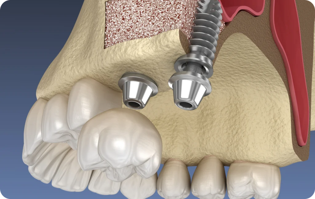 Sinus lift Dentistes à Cagnes-sur-Mer, Drs Payam & Pegah Gandjidadeh