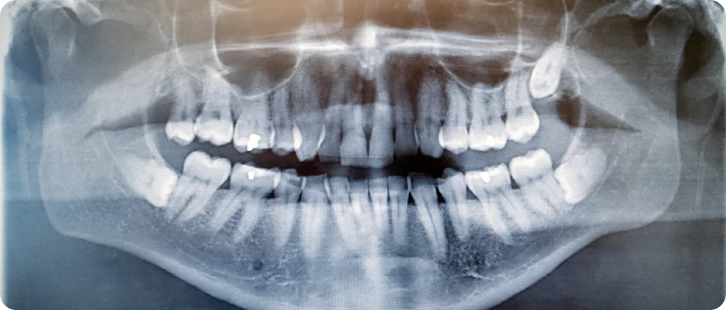 Dental implant in Vence Dentistes à Cagnes-sur-Mer, Drs Payam & Pegah Gandjidadeh